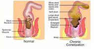 Obat Susah Buang Air Besar