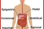 Obat Herbal Hernia