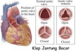 Obat Jantung Bocor